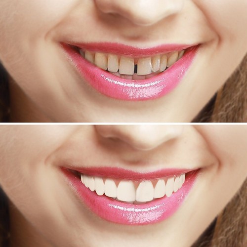 Imako kosmetik zähne snap on - kosmetik,