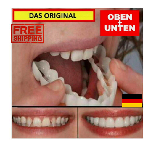 Snap veneers kosmetische - veneers,